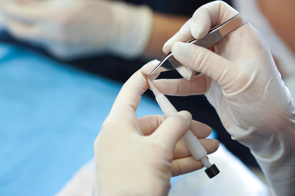 Image of a technician loading implanter with a hair follicle