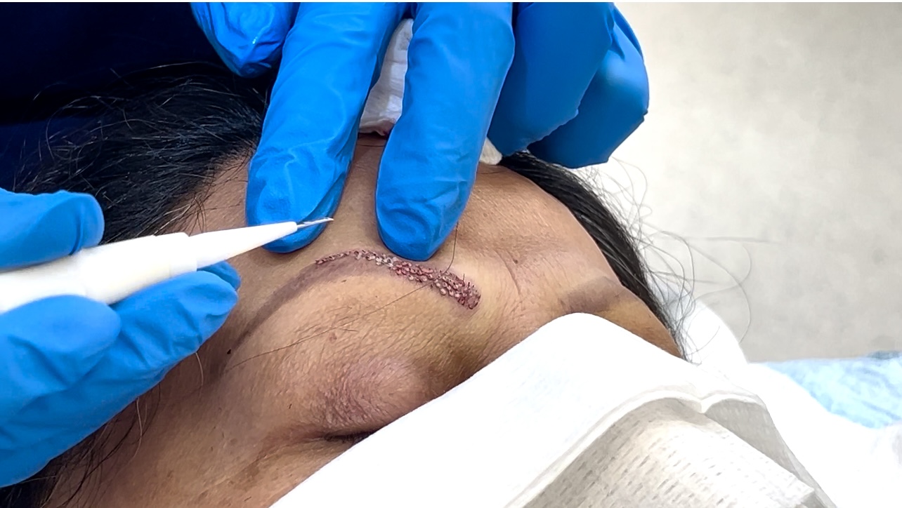 Eyebrow transplant with neatly placed hair in eyebrow region