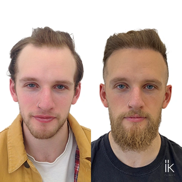 Before & after hair transplant